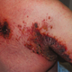 Illustration for article titled Obat Penyakit Herpes Zoster